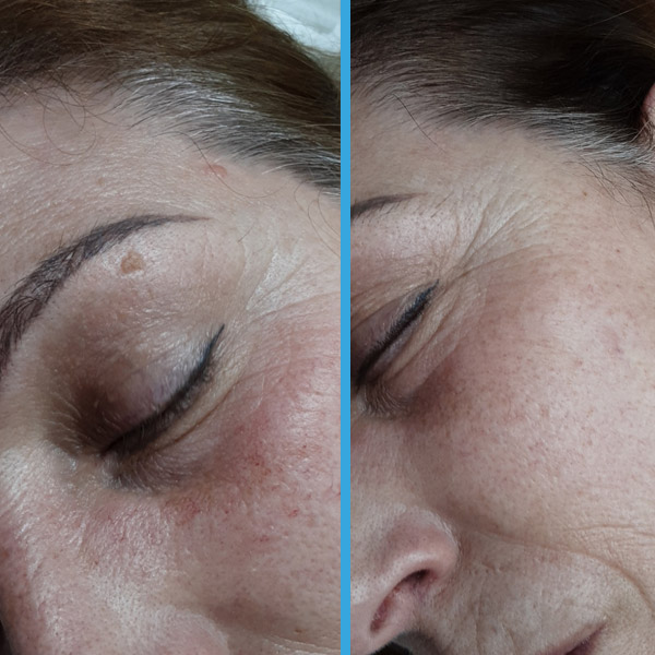 Before and after — A fibroma on the eyebrow